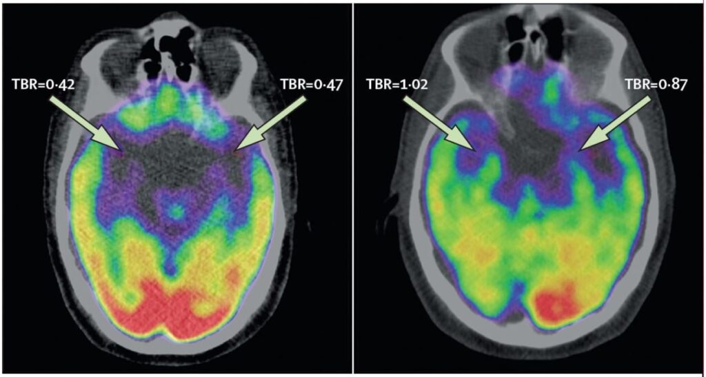 A PET scan showing chronic stress on  brain